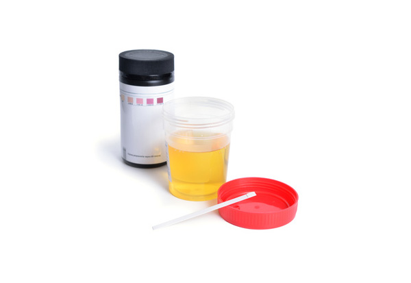 Une analyse des urines pour déceler l'acidose métabolique latente